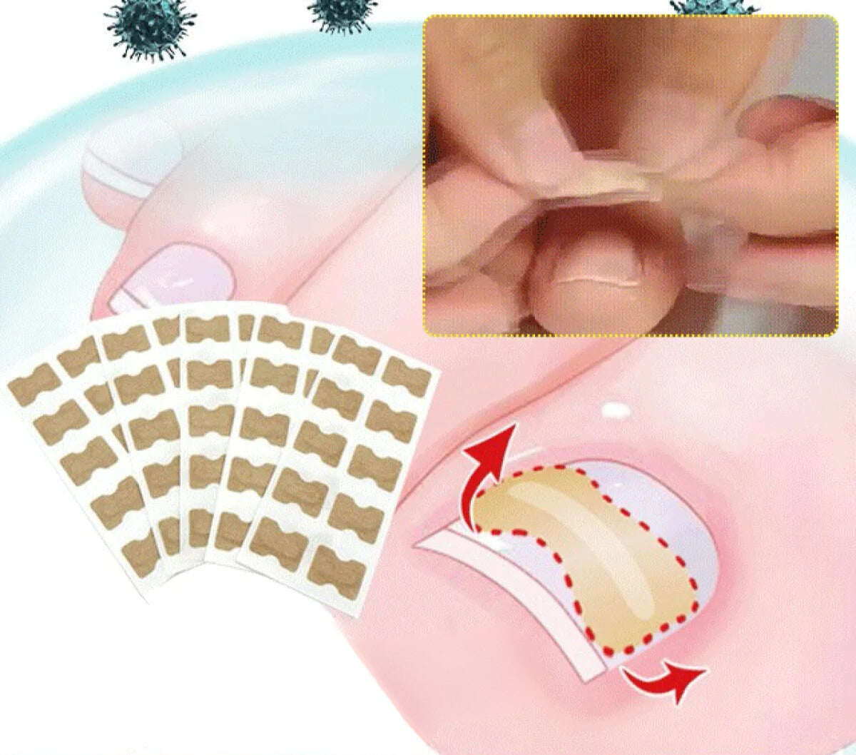 PARCHES PARA CORREGIR UÑAS ENCARNADAS - PACK 30 PCS