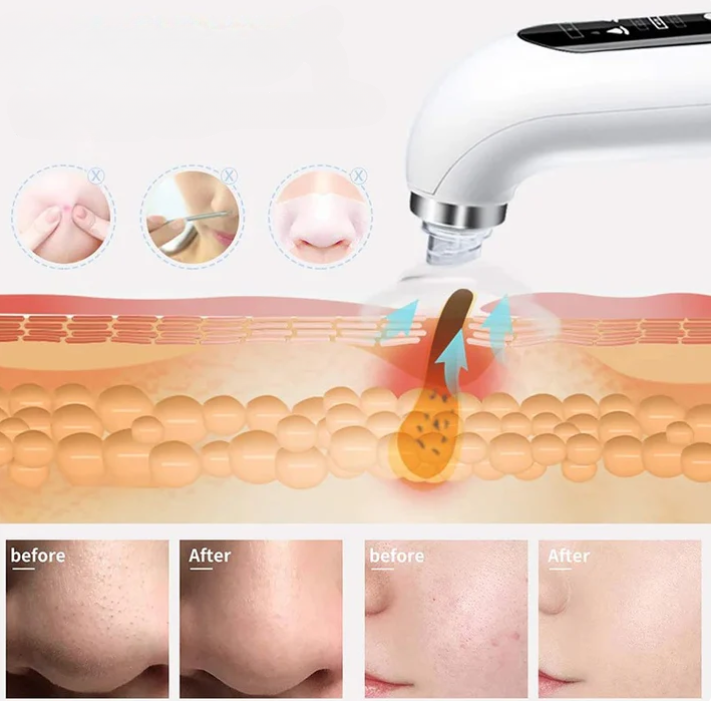 EXTRACTOR HIDROFACIAL DE IMPUREZAS