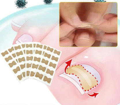 PARCHES PARA CORREGIR UÑAS ENCARNADAS - PACK 30 PCS